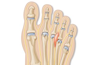 Illustration showing the bones in the top of the foot or toe area. There is a red area between the joints of the 3rd and 4th toes, showing the nerve Morton’s neuroma usually affects.