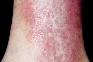 Varicose eczema on white skin. A red, crusty rash covering part of the lower leg.