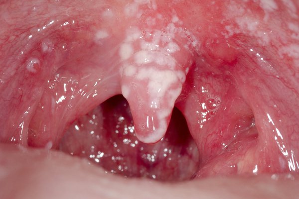 mild oral thrush on tongue