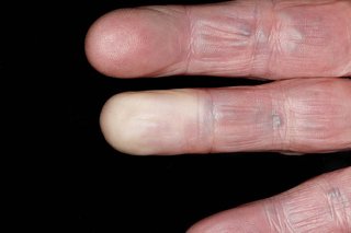 Fingers of a person with white skin. One fingertip is pale while the rest of the skin is pink.