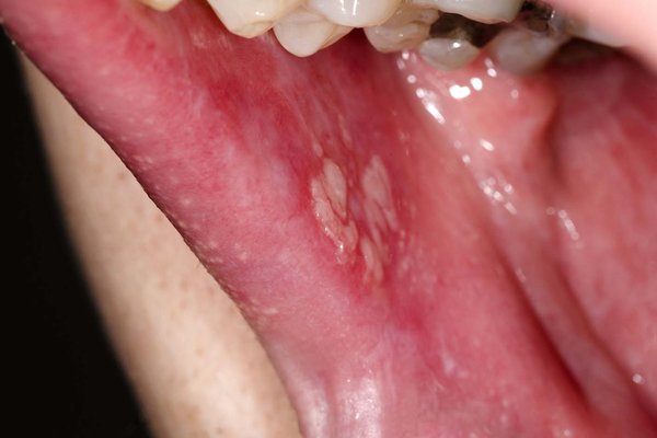 White patches of lichen planus in the mouth of someone with white skin.