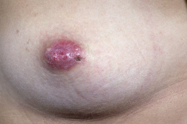 Picture of woman with Paget's disease of the nipple