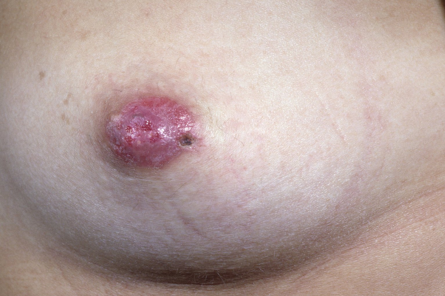Skin diseases of the breast and nipple
