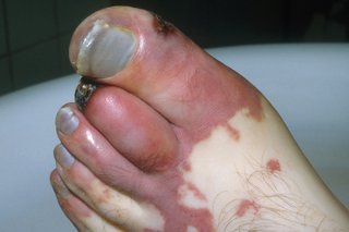 Foot with red toes and small black patches on some toes, on white skin.