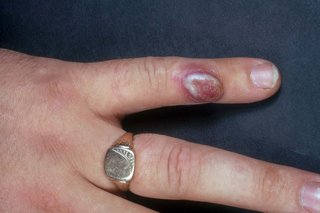 A large blister on the little finger of a person with white skin. There is a dark red or purple patch with a white blister in the middle.