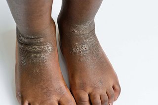 Patches of grey, scaly skin on a child's ankles and feet, caused by eczema. Shown on dark brown skin.