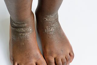 Patches of grey, scaly skin on a child's ankles and feet, caused by eczema. Shown on dark brown skin.
