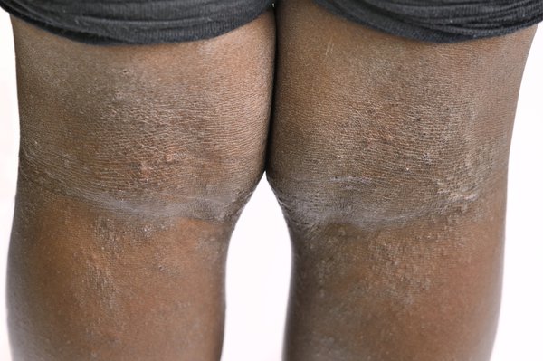 The back of the knees of a person with brown skin. The skin has many small bumps and looks grey around the creases at the back of the knees.