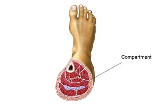 Picture of compartment syndrome