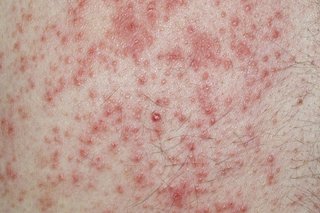 A patch of white skin affected by a red rash caused by contact dermatitis