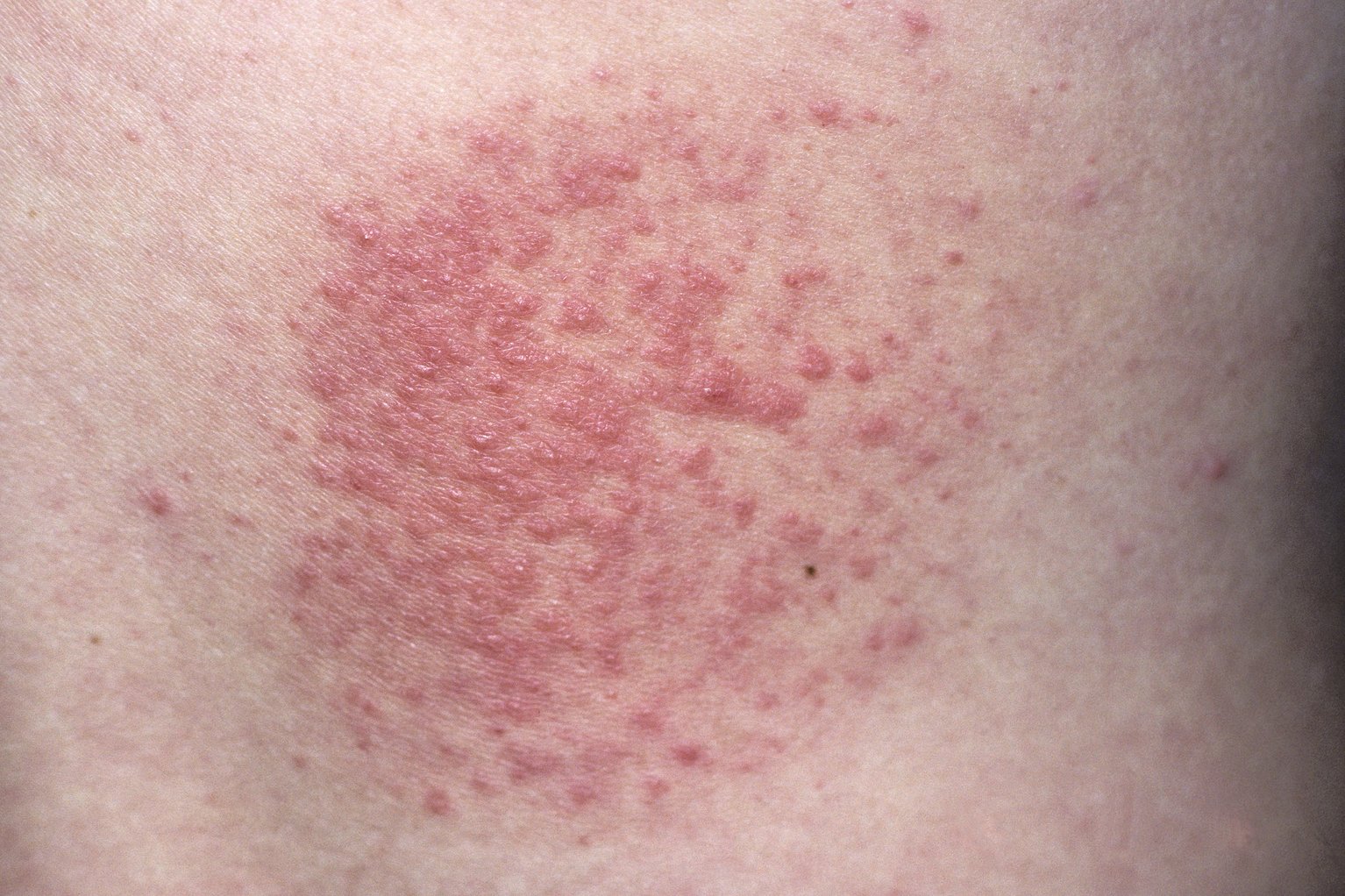 smallpox skin eruption