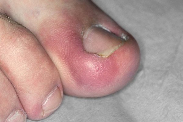 Identifying When Your Ingrown Toenail Requires Medical Attention: Eric  Blanson, DPM: Sports Medicine