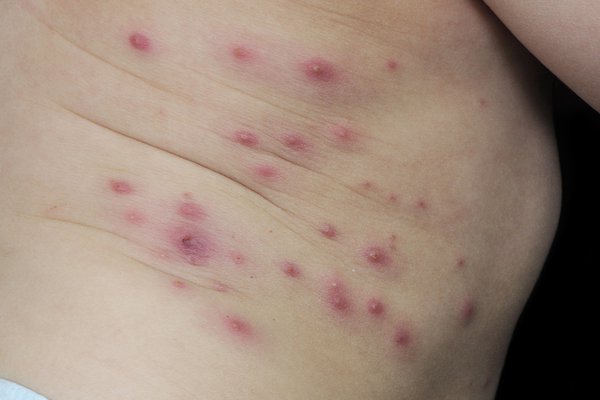Impetigo blisters on a young child's torso