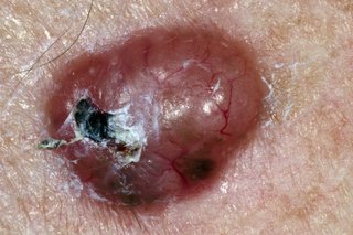 Picture of non-melanoma skin cancer