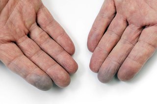 Hands of a person with white skin. The fingertips of the index and middle finger on each hand are blue.