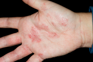 Pompholyx on the hand of someone with white skin. There are several red, sore patches on the fingers and palm.