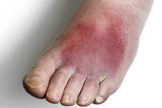 A patch of dark red skin on the top of a foot, caused by cellulitis. Shown on white skin.