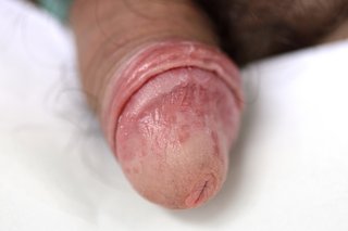 A penis with red, irritated skin caused by thrush. Shown on white skin.