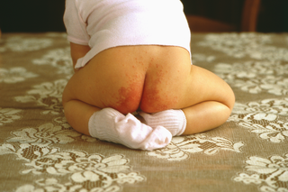 Nappy rash on a baby with white skin. The skin around the bottom is red and blotchy.