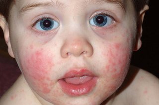 Bright red, raised spots covering a child's cheeks. Many of the spots have joined together. Shown on white skin.