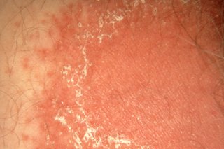 A red patch of skin with a white discharge caused by thrush. Shown on white skin.