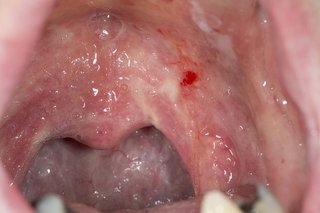 What causes thrush on the clearance tongue