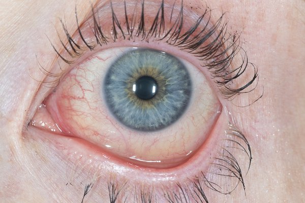 Pink eye: What are the first symptoms?