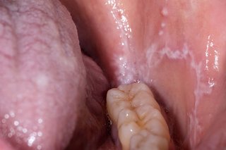 white skin inside of cheek