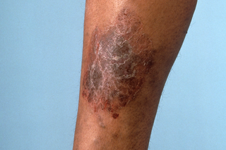 Varicose eczema on medium brown skin. A dark brown and purple scaly rash covering part of the lower leg.