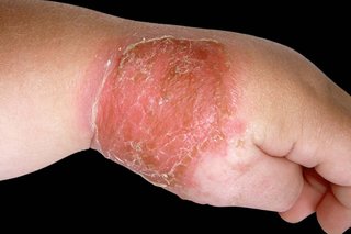 Impetigo shown on white skin. There's a large, red patch of skin with sores and crusts across the top of the hand.