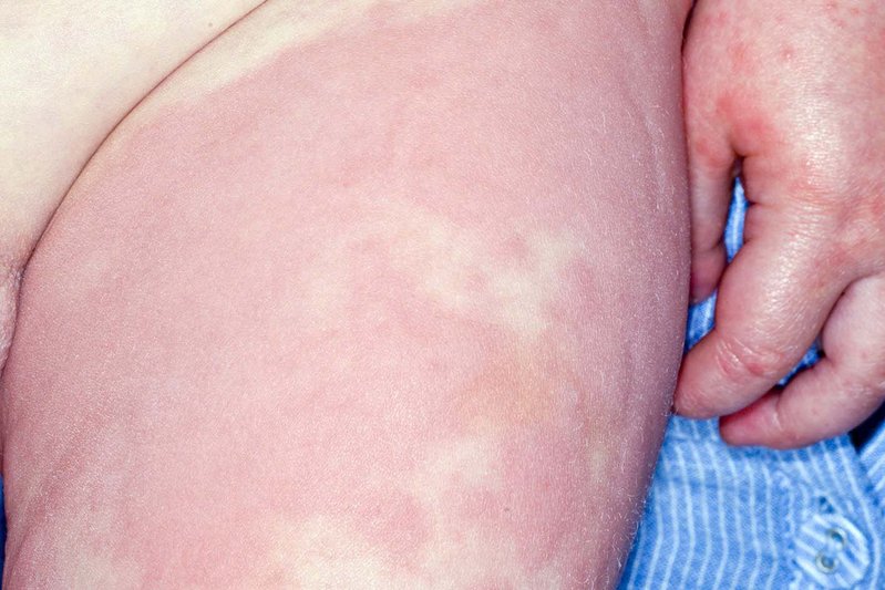 Nhs Images Rash Hives - NHS