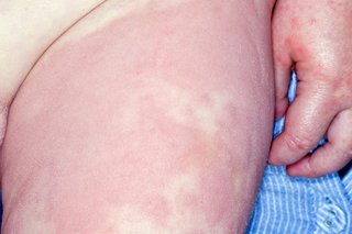 Raised, red patches across a baby’s thigh and some small red spots on their hand, caused by hives. Shown on white skin.