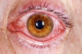 An eye that's red, caused by conjunctivitis