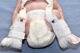 A fabric harness around a baby's feet and legs, holding the baby's hips in an open position.