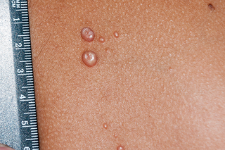 Raised, skin-coloured, fluid-filled spots from molluscum contagiosum. They’re 1mm to 5mm. Shown on medium brown skin.