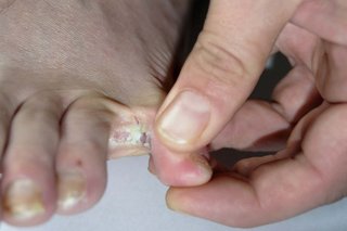 Athlete's foot on light brown skin. A hand holds open some toes. Between 2 toes is a scaly white patch.