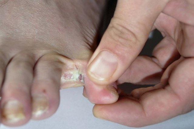 cracked pinky toe