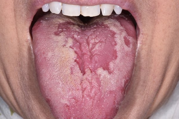 A tongue with blotchy patches, poking out of a person's mouth. Some of the patches are red and some are white.