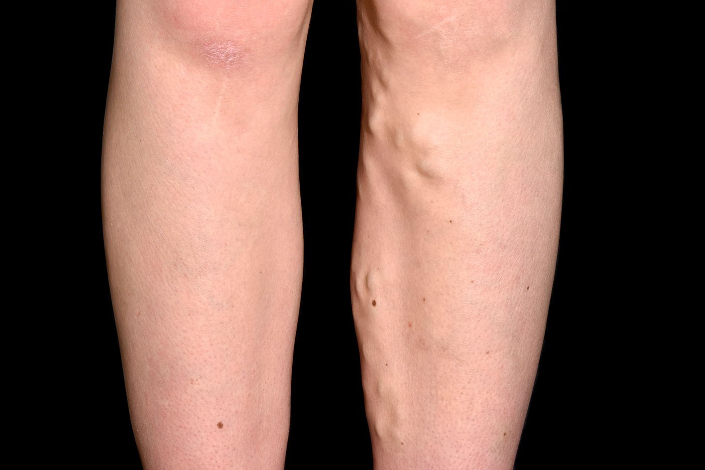 When to seek treatment for varicose veins.