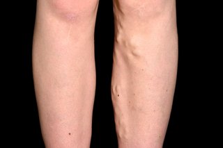 The lower legs of a person with white skin. The inner side of their left leg has varicose veins which look like raised lumps under the skin.