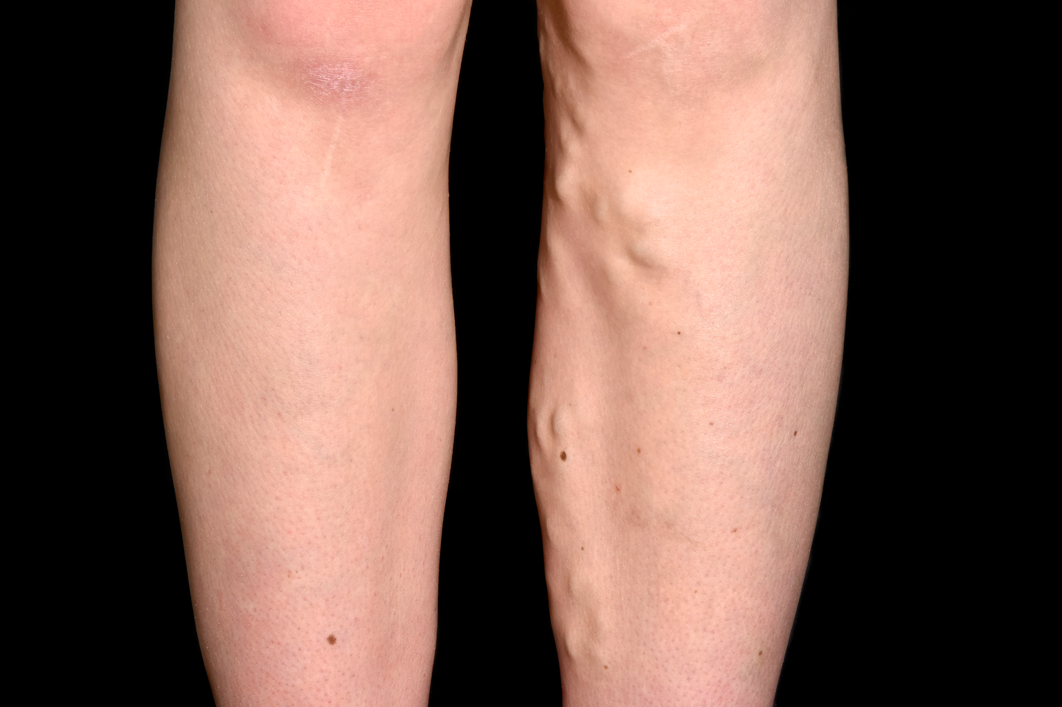 Varicose veins - NHS