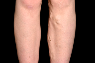 The lower legs of a person with white skin. The inner side of their left leg has varicose veins which look like raised lumps under the skin.