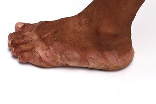 A foot with blisters and patches of light brown and pink peeling skin around the edge and on the toes. Shown on medium brown skin.