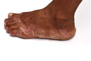 A foot with blisters and patches of light brown and pink peeling skin around the edge and on the toes. Shown on medium brown skin.