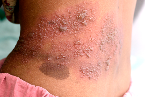 Shingles on Your Leg and Groin: Symptoms, Pictures, and More