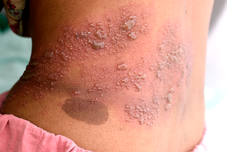 Shingles rash shown on medium brown skin. Pink rash with many small brown blisters on one side of a person’s lower back.