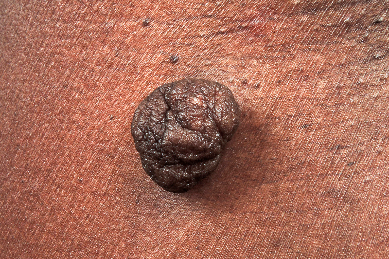 Image of Skin Tags