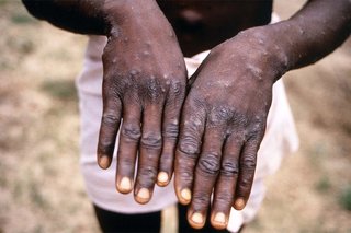 Raised spots on someone's hands and arms, caused by Mpox, shown on dark brown skin.