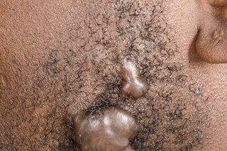 Keloid scars shown on medium brown skin. There's 2 raised, shiny, skin-coloured scars on a person's cheek.