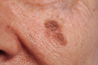 A large brown, irregular shaped melanoma on a person's left cheek, close to their nose. Shown is on white skin.